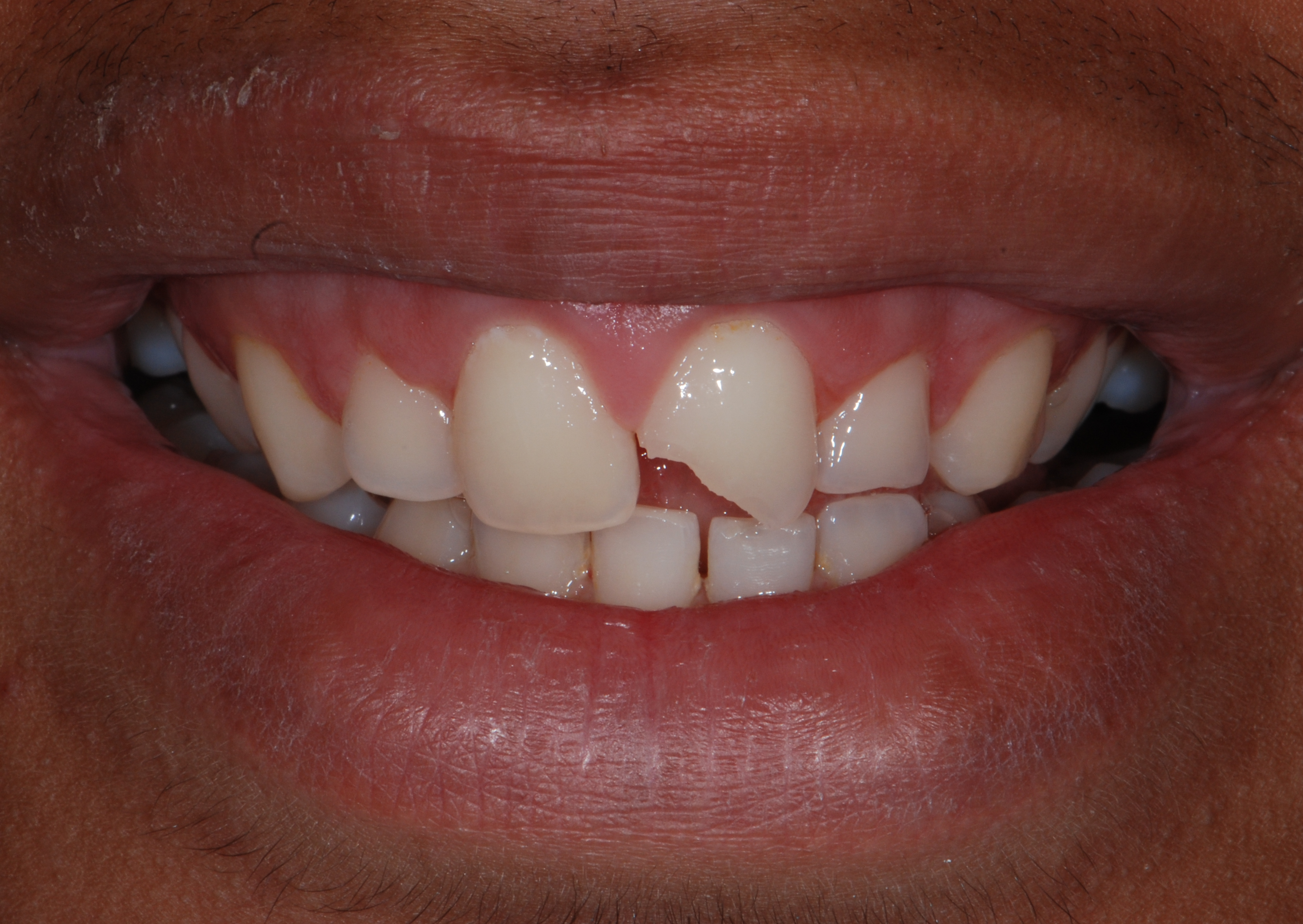 What is Dental Bonding? West Nyack Dentist Explains