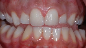 Teeth After Composite Filling